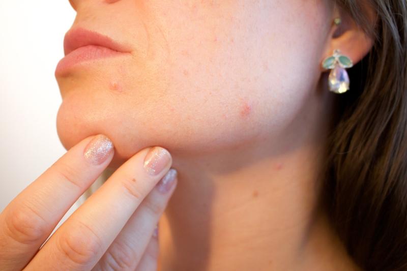 Acne Treatment Routine for Clearer Skin