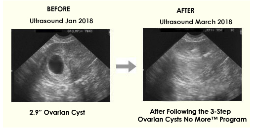 Ovarian cyst before & after