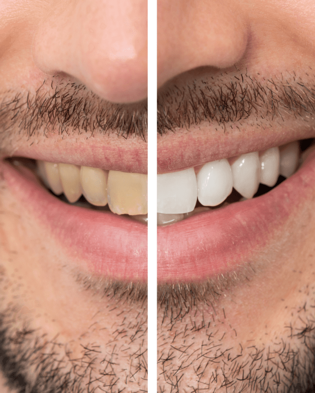 Whitening & Esthetics