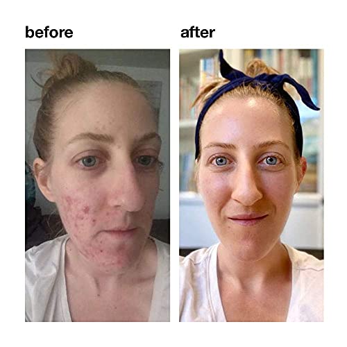 VitaMedica Clear Skin Vitamins for Acne Relief