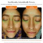 ReGlow 24K Gold Microneedling System for Radiant Skin