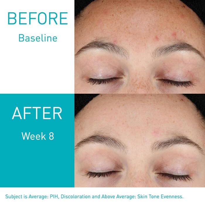 CeraVe Retinol Serum: Acne Marks & Skin Refinement