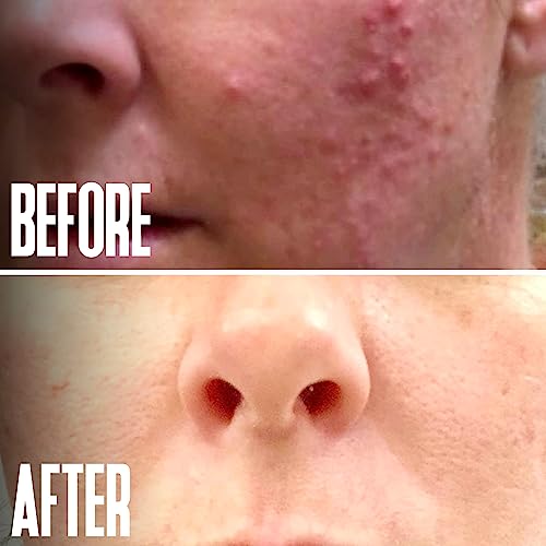 Professional Glycolic Acid Peel for Acne Scars & Wrinkles