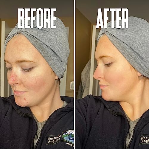 Professional Glycolic Acid Peel for Acne Scars & Wrinkles