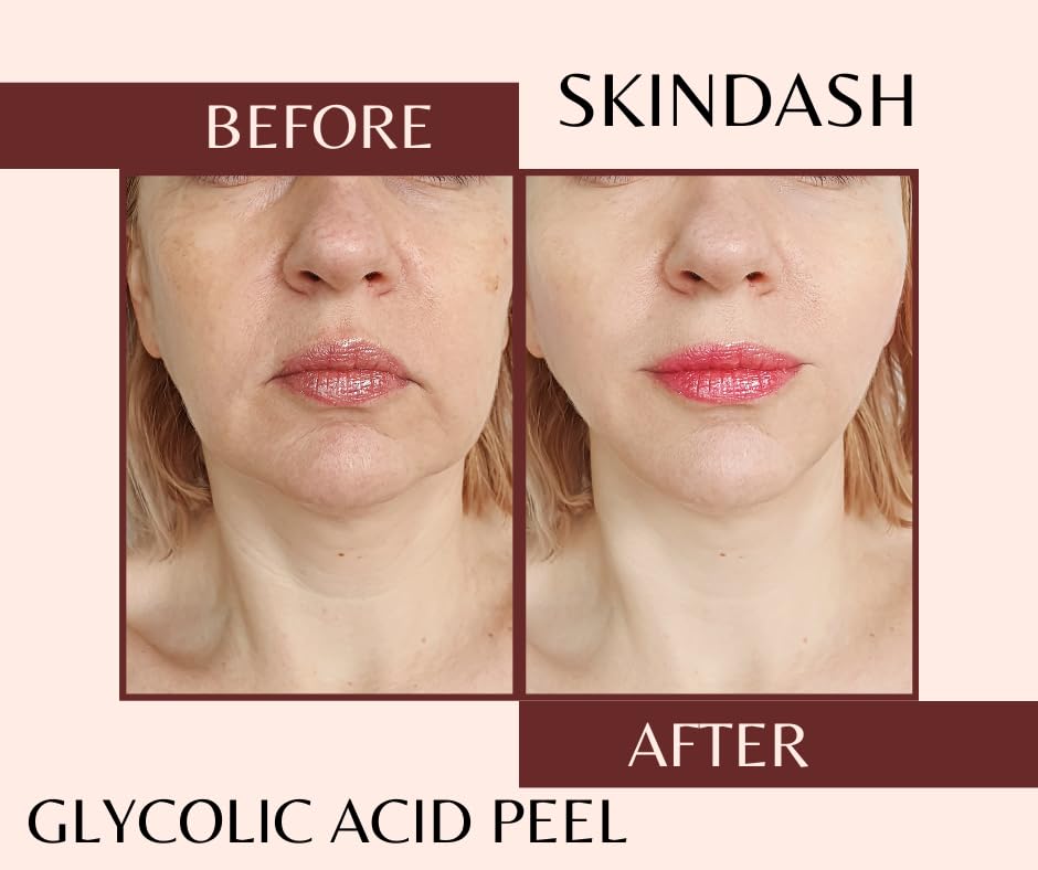 Youthful Glow: 70% Glycolic Acid Peel for Skin