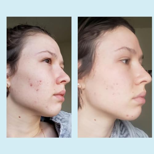 50% Glycolic Acid Gel Peel with Retinol & Green Tea