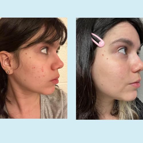 50% Glycolic Acid Gel Peel with Retinol & Green Tea