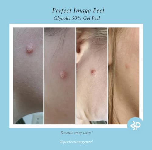 50% Glycolic Acid Gel Peel with Retinol & Green Tea