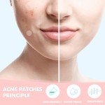 Sundpik Hydrocolloid Acne Patches - 304pcs