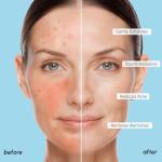 MAREE Glycolic Acid Peel Pads with Tea Tree Oil