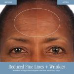 SKINN DermAppeal® Microdermabrasion Treatment for Smoother, Brighter, and Clearer Skin, 2oz - Exfoliating Facial Scrub Removes Dead Skin and Smooths Wrinkles and Fine Lines for Flawless, Glowing Skin