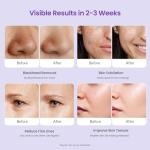 Diamond Microdermabrasion Machine for Salon and Home Use