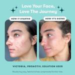 Proactiv 3 Step Acne Treatment - Benzoyl Peroxide Face Wash, Repairing Acne Spot Treatment for Face and Body, Exfoliating Toner - 30 Day Complete Acne Skin Care Kit