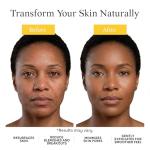 Suki Skincare Resurfacing Enzyme Peel - With Glycolic Acid, Papain, Apple, & Pumpkin - Chemical Exfoliant that Reduces Dry Skin Buildup While Promoting Radiant, Smooth, Soft Skin - 30 ml