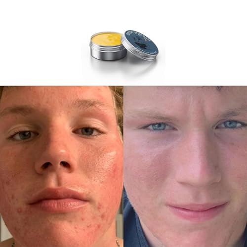 Norse Organics Acne & Redness Killer, Norse Organics Acne Balm, Acne Remove Skin Care Set, Ultra-Performance Skincare, Acne Clearing Cream for Man (1pc) q