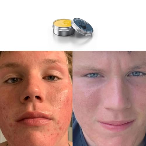 2pcs Norse Organics Acne & Redness Killer, Norse Organics Acne Balm, Acne Remove Skin Care Set, Acne Face Cream, Acne Clearing Cream for Teens Adults, Skin Nourishing Cream