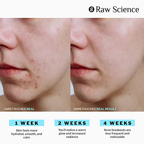 Anti Acne Supplements Cystic Acne Treatment for Teens – Hormonal Acne Pills with Acne Vitamins for Men & Women – clear skin supplement: Vitamin A, Zinc, Niacin Oily Skin & Breakout Control - 60 Caps