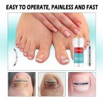 Titanium Ingrown Nail Correction Tool Set