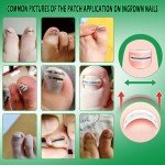 Titanium Ingrown Toenail Treatment and Repair Kit