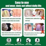 Titanium Ingrown Toenail Repair Kit (10 pcs)