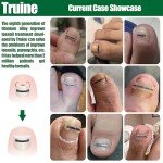 Titanium Ingrown Toenail Repair Kit (10 pcs)