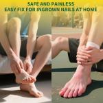 Titanium Ingrown Toenail Treatment and Removal Kit