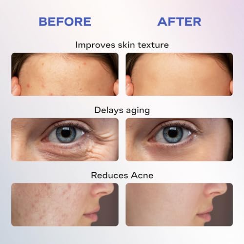 FDA Cleared LED Face Mask - Acne & Wrinkles