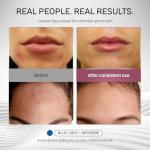 Numiere Time Keeper LED Face Mask – Multi-Wavelength Skincare Device