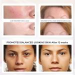 QuasarMD 3D LED Face Mask for Radiant Skin