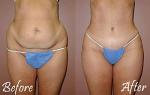 Miracle Slimming Tummy Tuck Belt - As Seen on TV