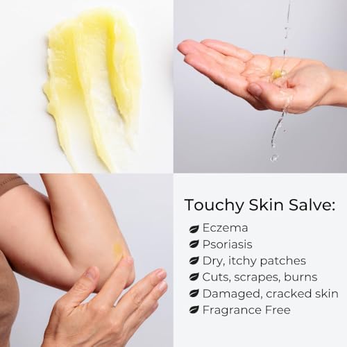 Ora's Herbal Touchy Skin Salve for Eczema