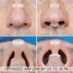 AIRMAX Nasal Dilator - Comfortable Snoring Solution