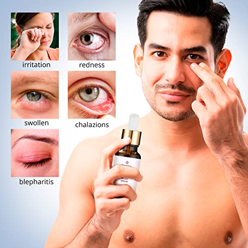 Stye Relief Serum for Fast Eye Treatment