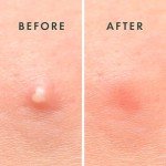 Hydrocolloid Acne Patches for Blemish Treatment