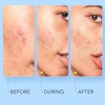 LitBear Large Hydrocolloid Pimple Patches - 112 Count