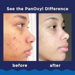 PanOxyl 10% Benzoyl Peroxide Acne Wash, 5.5 Oz