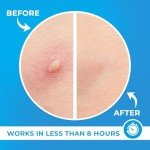 Hydrocolloid Pimple Patches for Acne Relief (120)