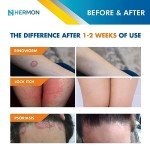 Hermon Antifungal Cream for Ringworm and Skin Issues
