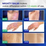 Extra Strength Toenail Fungus Treatment Cream