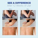 Extra Strength Antifungal Cream for Skin Irritations