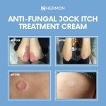 Antifungal Cream for Jock Itch, Psoriasis, Ringworm
