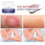 Extra Strength Antifungal Cream for Itchy Skin