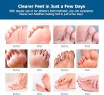 Roycederm Extra Strength Athlete’s Foot Treatment Cream