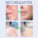 Tinea Versicolor Antifungal Skin Treatment Cream 2.02oz