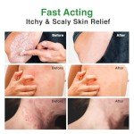 Antifungal Spray for Ringworm and Itchy Skin