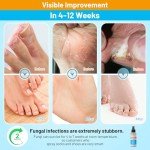 Athlete’s Foot Spray - Fast Relief for Itch & Odor