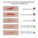 Silicone Scar Sheet, Silicone Scar Tape for Surgery (1.6” x120” Roll-300CM), Silicone Scar Strips, Keloid Treatment, C-Sections, Surgical Scars, C-Section Scars