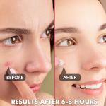 Invisible Acne Patches - 180 Count, Two Sizes