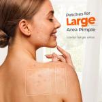 Large Hydrocolloid Pimple Patches - 126 Count