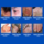 Hermon Antifungal Cream for Ringworm and Skin Issues